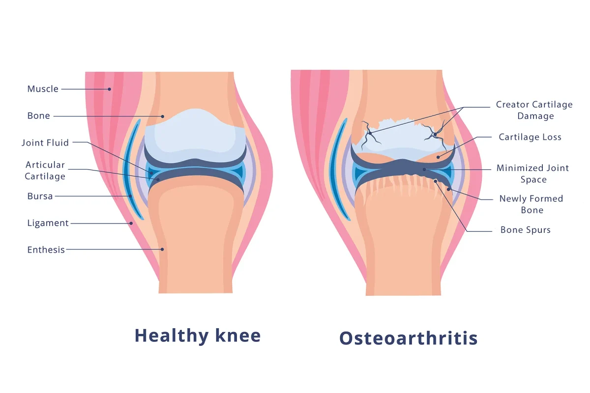 knee replacement surgery diagram showing joint surfaces and implant components