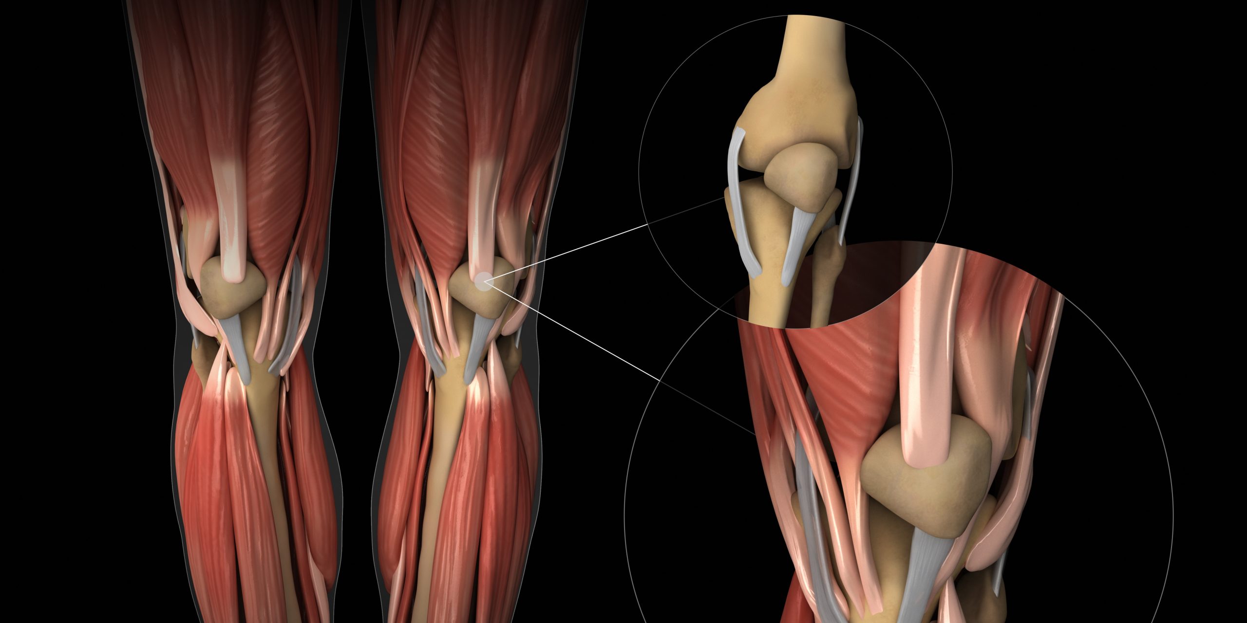 Knee Pain from Patellar Tendonitis
