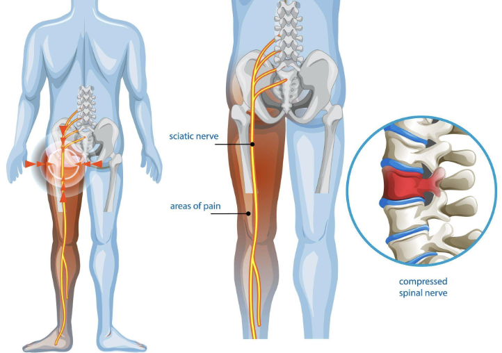 Sciatica Pain